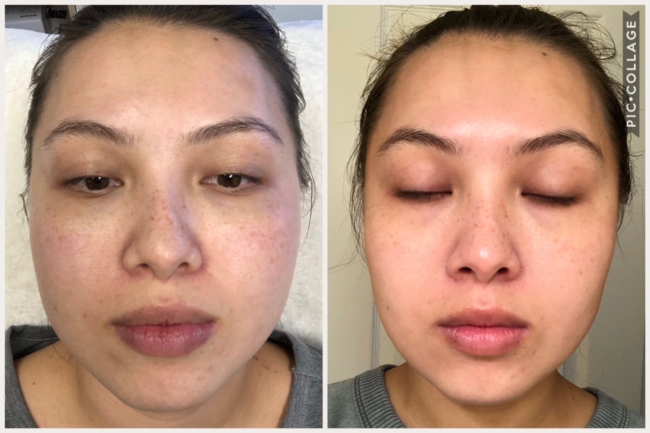 Facial Slimming Injections & Treatments