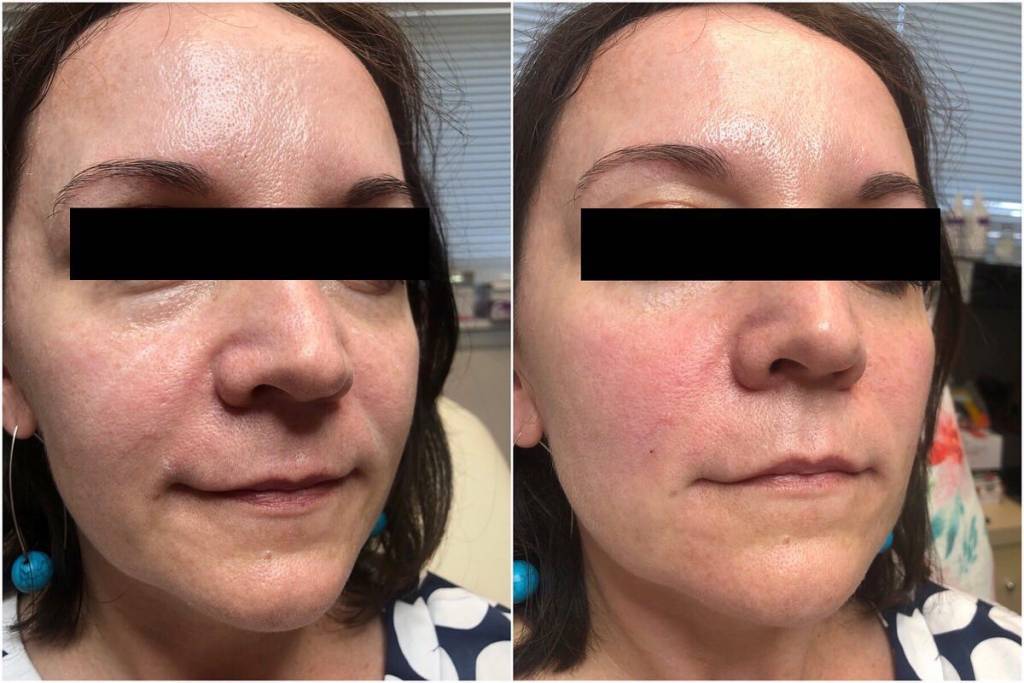 Injectables. Prolase Medispa Laser Hair Removal & Skin Care Center