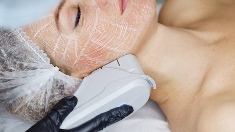 IPL Photorejuvenation