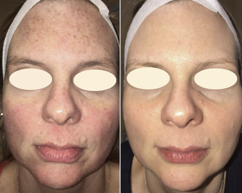 IPL Photofacial at Prolase Medispa Sun spots, age spots, Redness and