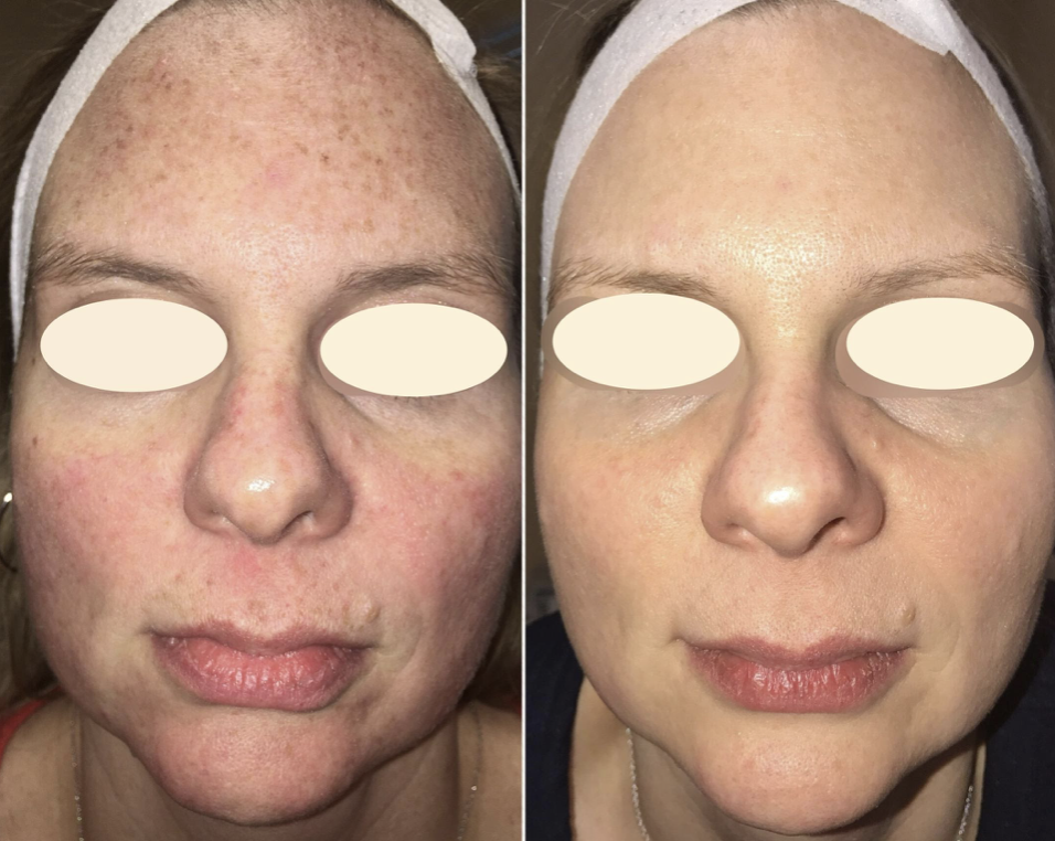 The Glass IPL Photofacial Review on dry acne prone skin - Bronwyn Papineau  - itshoneybii - Lifestyle Skincare Travel