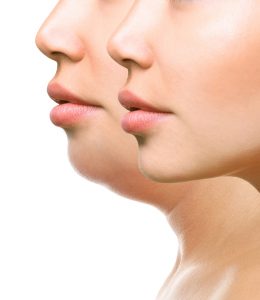 Does Kybella Work?