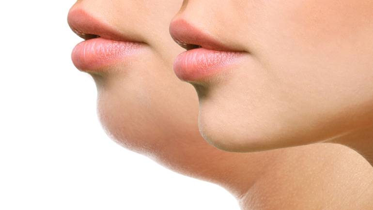 Does Kybella Work?