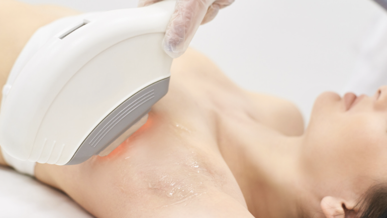 Laser Hair Removal Cost Near Annandale