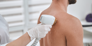 Laser Hair Removal in Purcellville Virginia