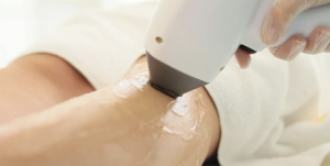 Laser Hair Removal Pricing in Sterling Virginia