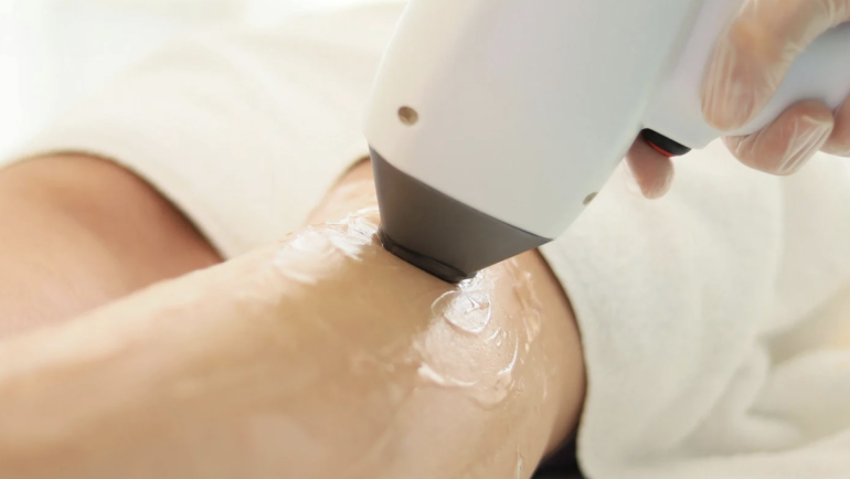 Laser Hair Removal Pricing in Sterling Virginia