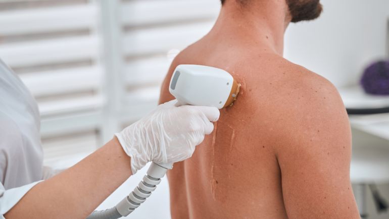 Low-Cost Laser Hair Removal in Purcellville, VA