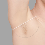 Laser Hair Removal Results Near Ashburn, VA