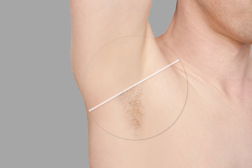 Laser Hair Removal Results Near Ashburn, VA