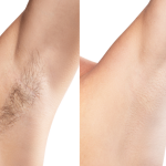 Real Patient Laser Hair Removal Before and Afters Near Sterling, VA
