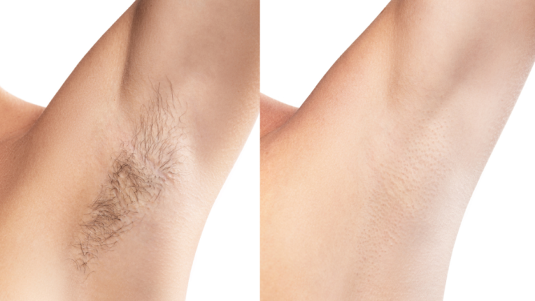 Real Patient Laser Hair Removal Before and Afters Near Sterling, VA