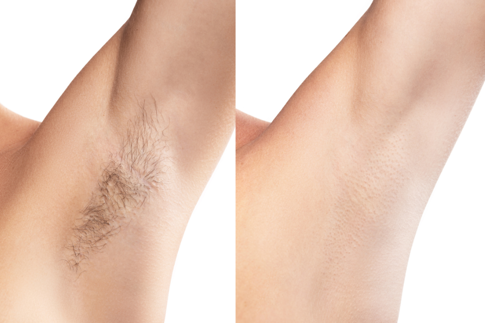 Real Patient Laser Hair Removal Before and Afters Near Sterling, VA