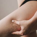 Best Cellulite Treatments in Northern Virginia: 3 Top Options
