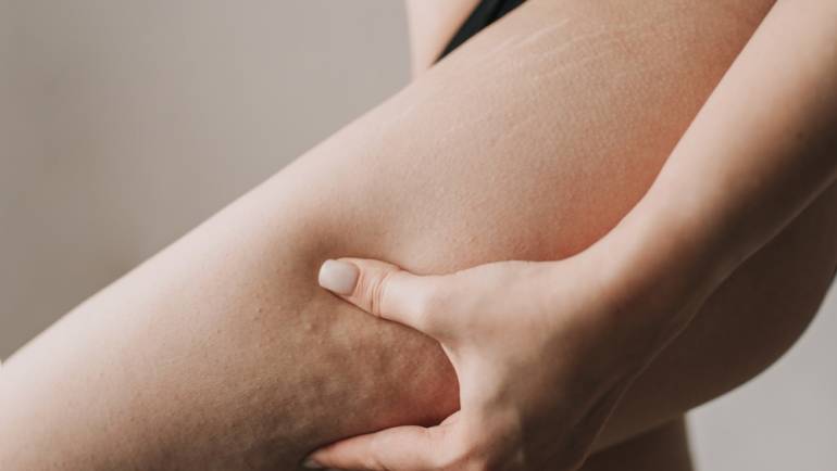 Best Cellulite Treatments in Northern Virginia: 3 Top Options