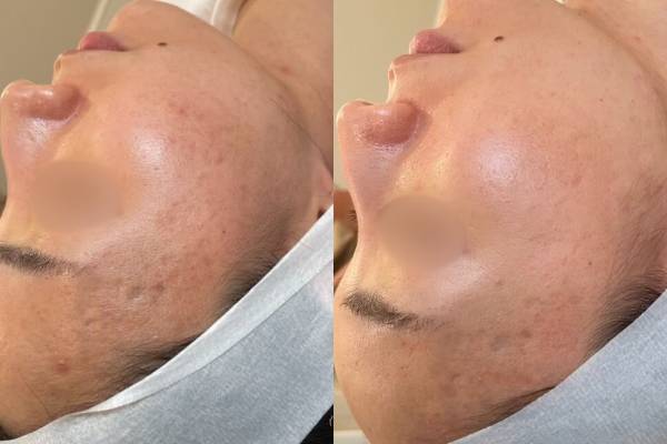 Microneedling