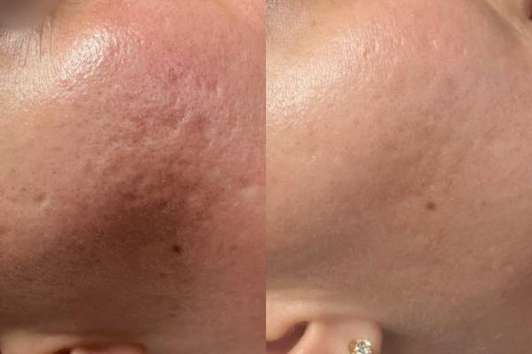 Microneedling