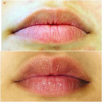 Dermal Fillers
