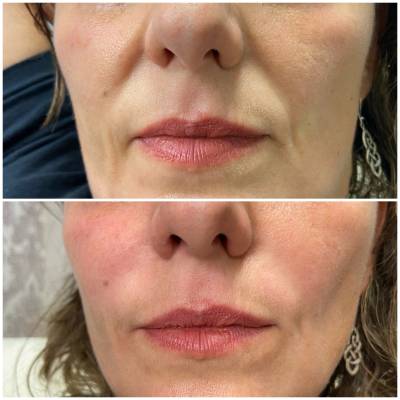 Dermal Fillers